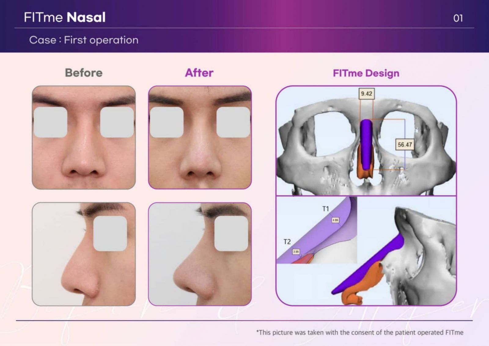 FITme Nasal — ca phẫu thuật đầu tiên, hình ảnh trước và sau cùng thiết kế cấy ghép 3D