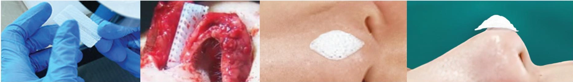 PCL scaffold handling and nasal application images from the Osteopore brochure