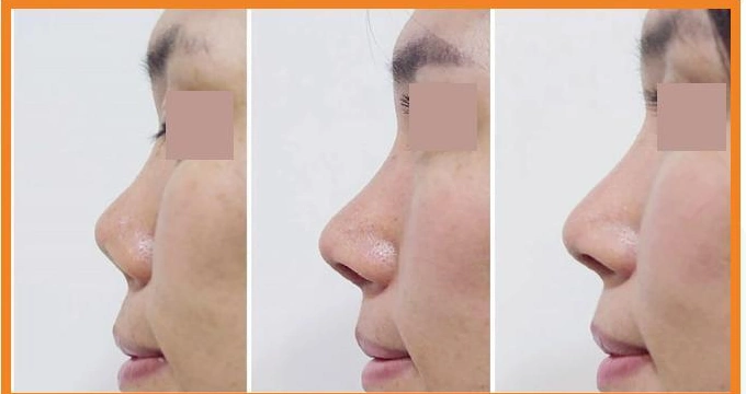 Chuỗi hình theo dõi góc mũi môi trong nghiên cứu Osteomesh được trình bày trong tài liệu