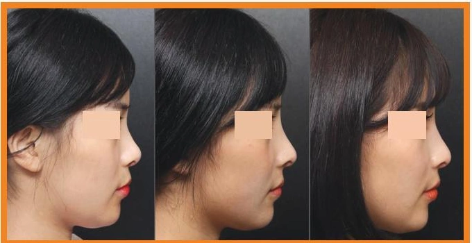 Chuỗi hình theo dõi Osteomesh trước phẫu thuật, sau 6 tháng và 26 tháng