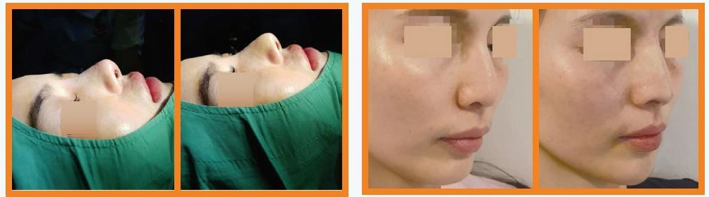 Before and after Anatomic Tipball examples in the Osteopore brochure